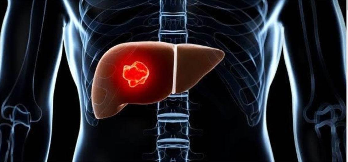 ADENOMA HEPATOCELULAR