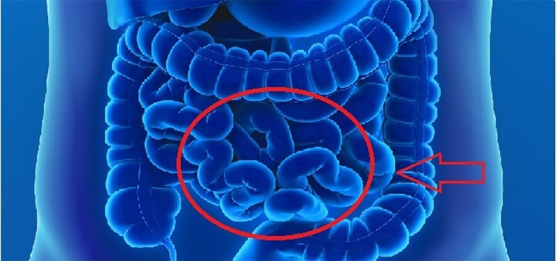 Câncer Intestino Delgado