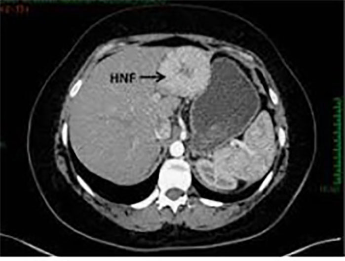 HIPERPLASIA NODULAR FOCAL