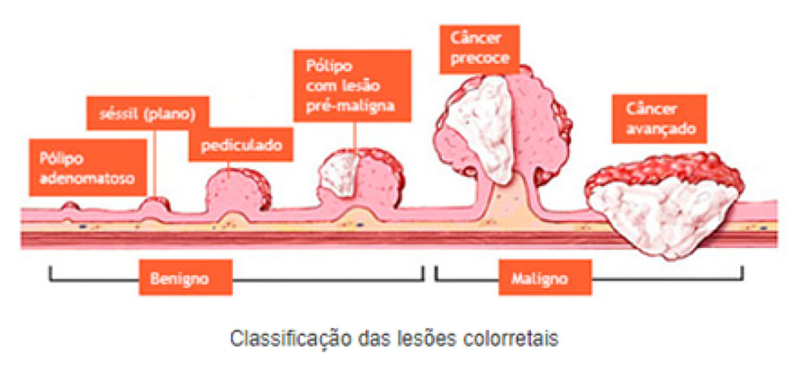 Pólipos intestinais e a relação com câncer colorretal